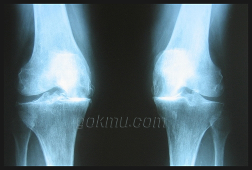실제 X-ray 선 사진 네이버