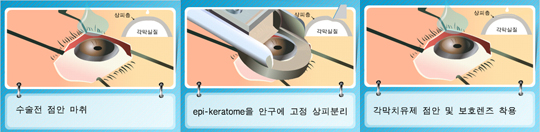 에피수술과정(좌로부터)