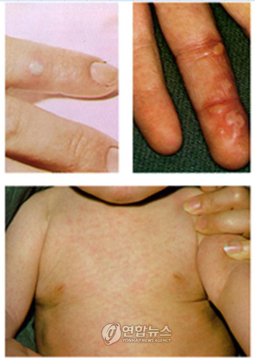 수족구 증상 모습(자료사진)
